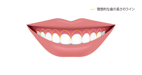 歯冠長延長術（CLP）